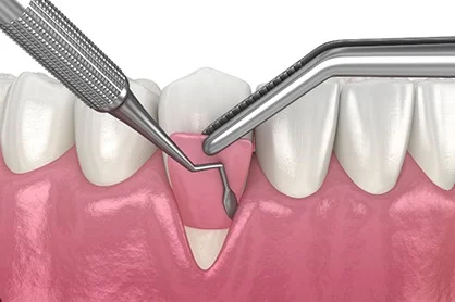 Match to Existing Natural Gum Tissue