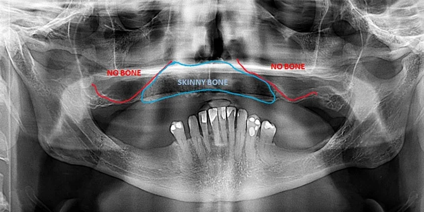 Severe Bone Loss