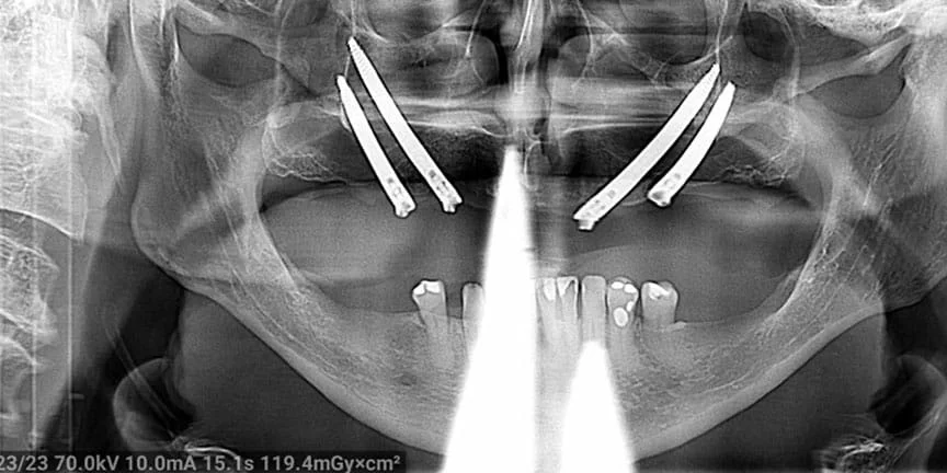 Severe Bone Loss