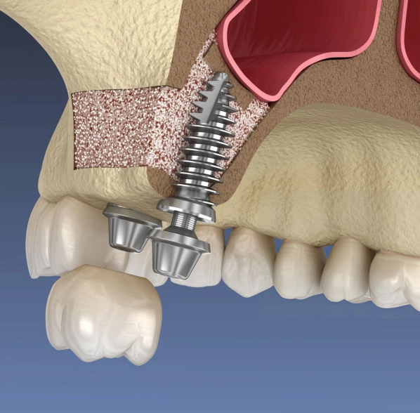 sinus lifts in Little rock